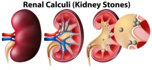 Imagem gráfica de rins na cor vermelha, com artérias azuis e vermelhas e com diferentes tipos de cálculos renais.