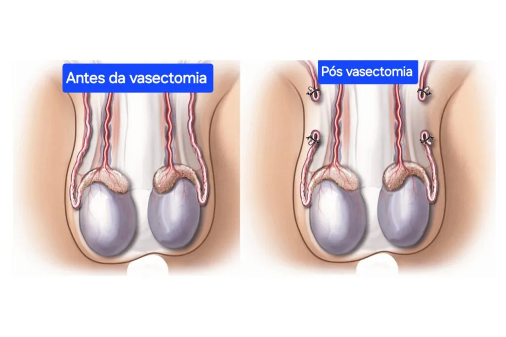 Imagem gráfica do interior de testículos mostrando antes e depois das vantagens da vasectomia.