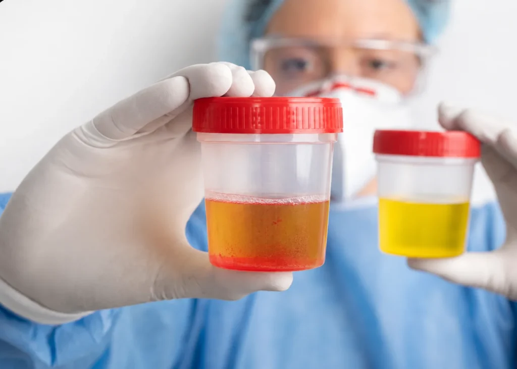 Profissional de saúde segura coleta com sangue na urina